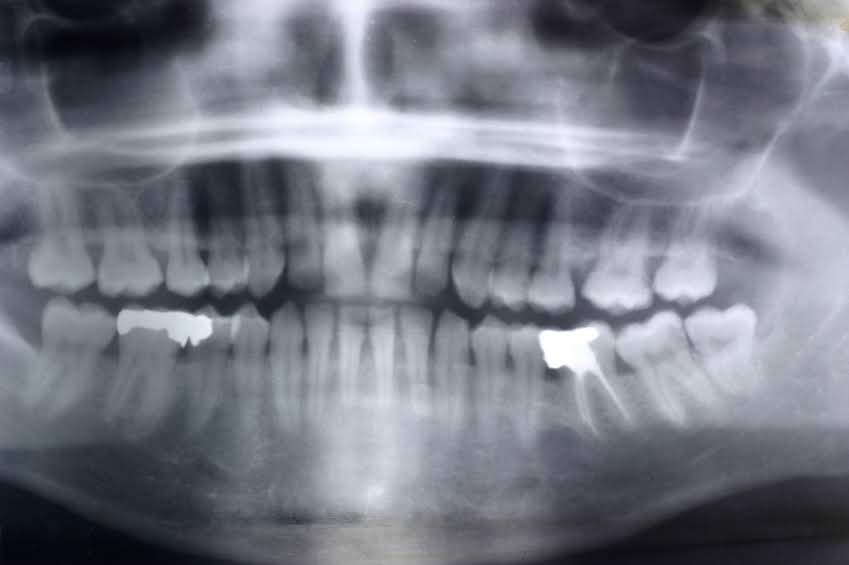 Dental X-rays in North York