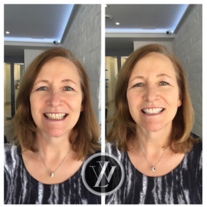 Teeth Whitening - Cosmetic dentistry North York