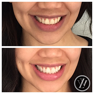 Teeth Whitening - Cosmetic dentistry North York