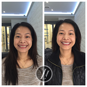 Teeth Whitening - Cosmetic dentistry North York